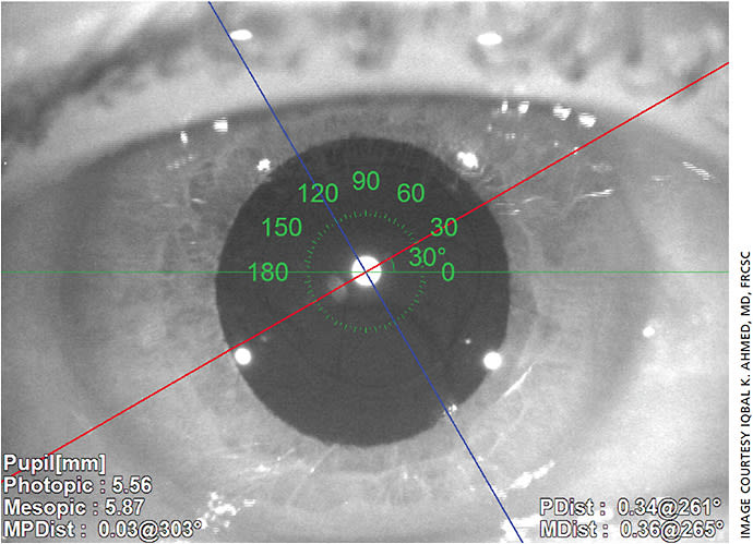 Figure 4. Two-week postoperative OPD Scan III (Nidek) of the AcrySof IQ Toric SN60AT IOL placed at 30 degrees (red line) of axis as calculated by the Toric Results Analyzer.