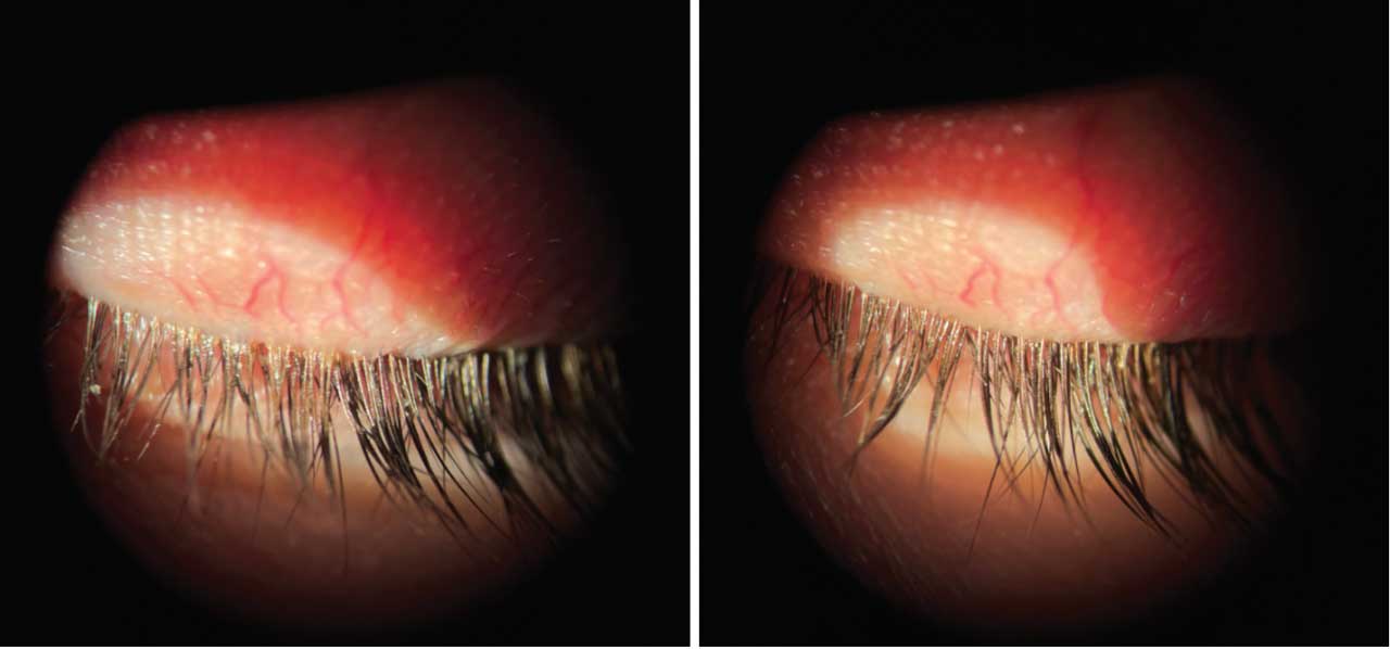 Before Xdemvy treatment (left) showing dense collarettes on the lash line. Marked improvement in collarettes was seen after 6-week course of Xdemvy (right).