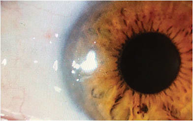 FIGURE 1B. An image of the patient three months postoperatively showing a healed conjunctiva without evidence of pterygia recurrence. IMAGE COURTESY ASHLEY BRISSETTE MD, MSC, FRCSC