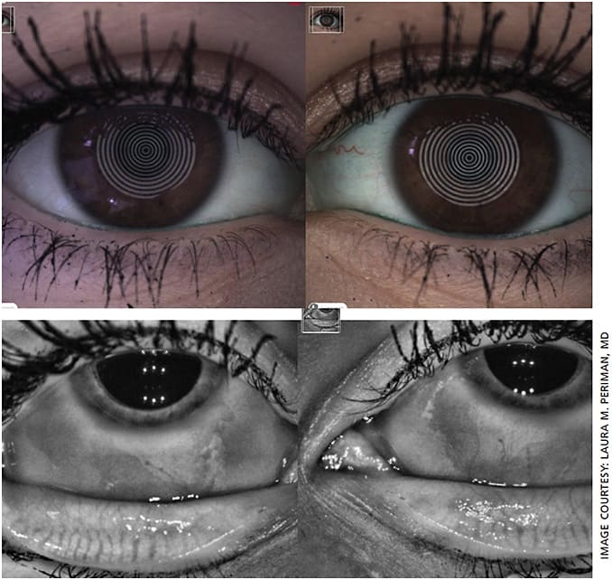 Figure 1. A 33-year-old female with complaints of dry, red eyes and change in appearance. The patient had used PGA adulterated OTC eyelash growth serum for years and had findings of orbital fat atrophy, hyperpigmentation, abnormally long eyelashes, dermatitis, MGD, dry eye and conjunctival injection.