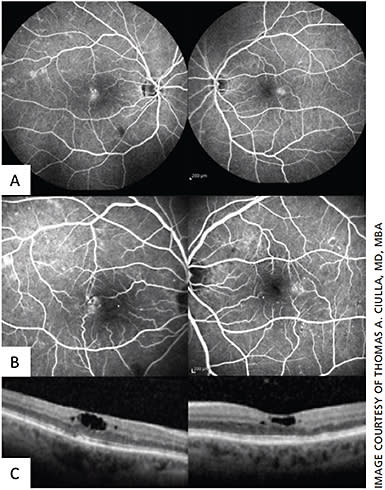 Figure 1. Pseudocysts in macular telangiectasia type 2.