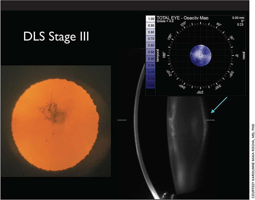 Figure 4. The iTrace&#8217;s opacity map makes this cortical cataract plainly visible.