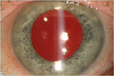 Figure 1. Trifocal IOL (AT Lisa, Zeiss)