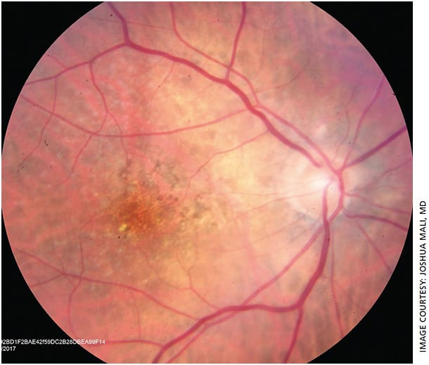 Figure 1. Fundus photo OD showing macular drusen and retinal pigment epithelium changes with no evidence of sub-retinal hemorrhage. Image taken with Topcon TRC-50EX.