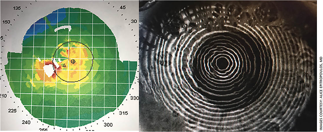 Figure 1. A patient with dry eye, which caused irregular astigmatism and made pre-op measurements inaccurate.