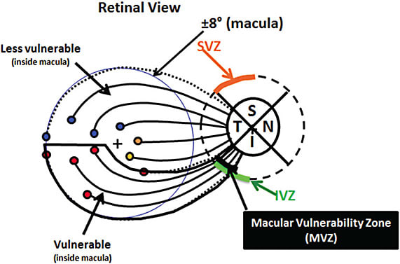 Figure 3. A schematic of an anatomical model showing the relationship between the location of the RGC on the retina (circles) and the location where their axons enter the disc. The solid ellipse represents the disc and the dashed circle the location of the OCT circle scan. The regions of the superior and inferior disc most vulnerable to axon loss are labelled SVZ (superior vulnerability zone) and IVZ (inferior vulnerability zone). Notice the axons from the RGC in the inferior portion of the macula enter the IVZ. This portion of the disc is the macular vulnerability zone (MVZ).