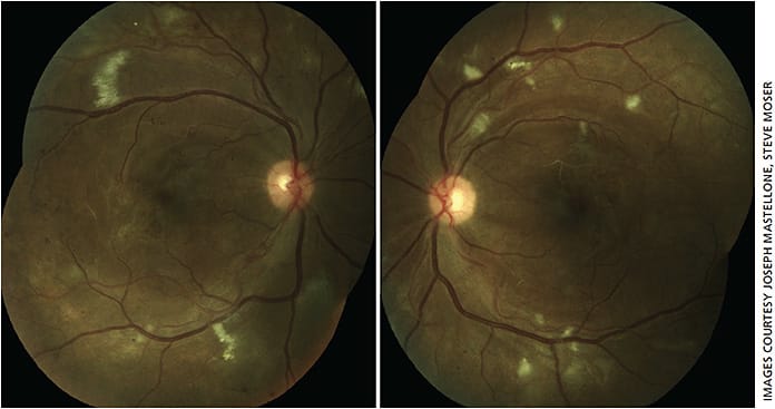 Figures 1a and 1b. Color fundus photo OU demonstrating bilateral macular ischemia with microaneurysms, multiple cotton wool spots and sclerotic vessels indicative of ischemic nonproliferative diabetic retinopathy and vaso-occlusive macular disease OU.