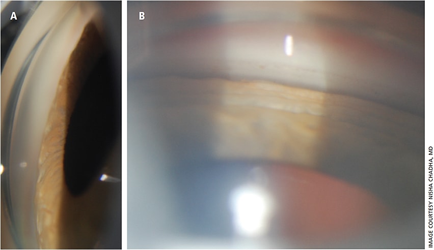 Figure 1: A. Slit lamp photograph of gonioscopy in acute TiACG - forward bowing of iris with no angle structures visible B. Slit lamp photograph of gonioscopy, one week after discontinuation of topiramate with deepened anterior chamber, and open angle (arrow pointing to trabecular meshwork).