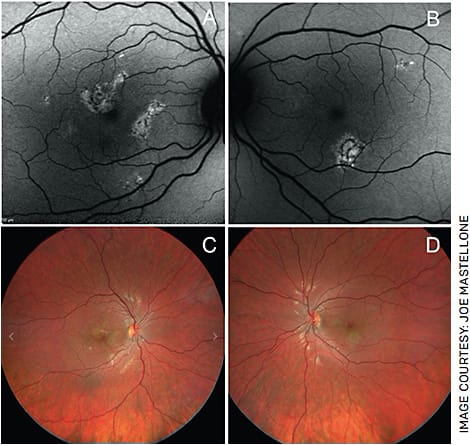 FIGURE 5. Repeat fundus autofluorescence imaging and fundus photos at 2 weeks. Hyper-autofluorescence signal is less at 2 weeks OU (A and B). The cream-colored lesions have started to fade from thick and creamy to more flat and pigmented OU (C and D), with the fovea becoming more distinct OD (C).