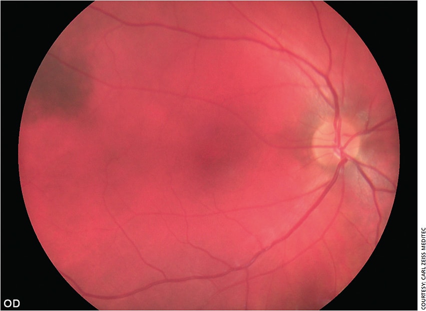 Figure 1. Normal fundus image of the right eye, taken by VISUSCOUT 100.
