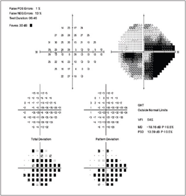 Figure 2. Humphrey visual field testing of the patient with steroid-induced glaucoma showing severe damage to the paracentral and peripheral visual fields in both the superior and inferior hemifields.