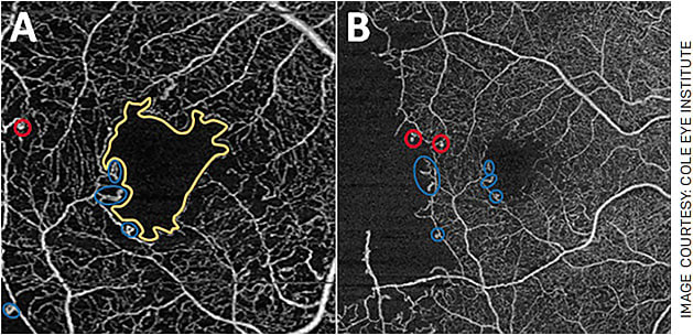 FIGURE 2. OCTA changes in diabetic retinopathy (DR)