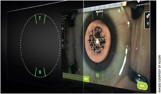 The ORA System with VerifEye Lynk offers image-guided, integrated cataract refractive procedures.