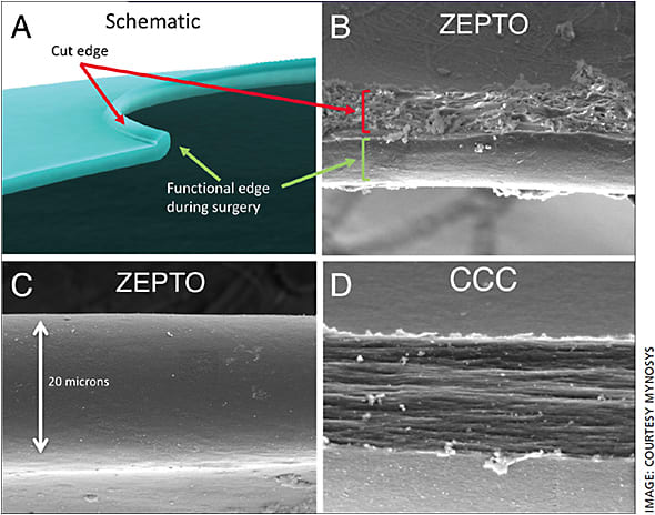 Figure. This scanning electron micrograph following Zepto capsulotomy shows the smooth edge with the treated edge reproducibly folded upwards. This is considered the explanation for the increased resistance to tear even compared to manual rhexis.