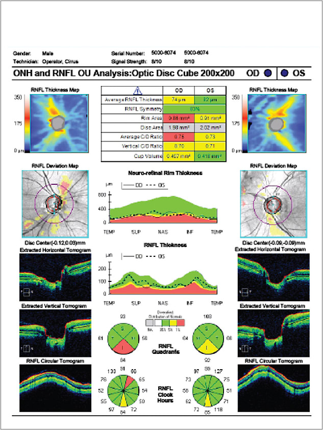 Figure 2. Case presentation of a 59-year-old Hispanic male who presented with a new onset disc hemorrhage. Baseline OCT, demonstrating focal nerve loss inferiorly OD over the region of the disc hemorrhage.