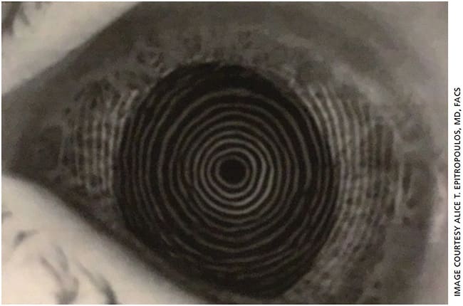 Figure 3A. The patient’s EBMD in his right eye was affecting his visual axis causing topographic irregularities, as seen in this Placido ring topography (Zeiss Atlas).