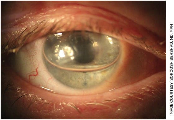 Clinical photograph of a patient postoperative day-one status post-DMEK with SF6 gas fill.