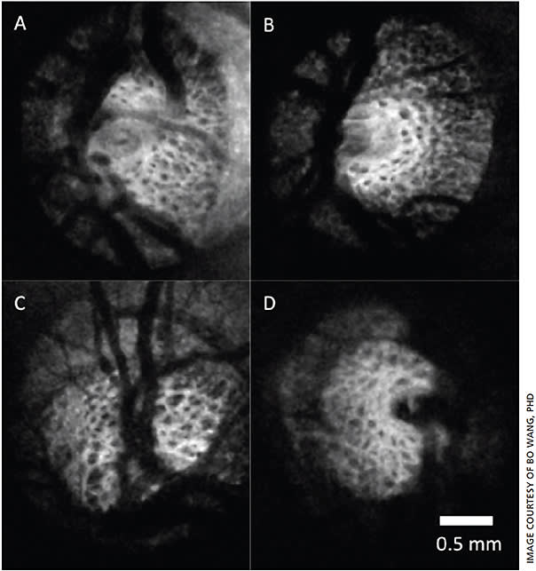 Lamina cribrosa C-mode of healthy (A-B) and glaucomatous (C-D) eyes. SS-OCT offers enhanced penetration into the optic nerve, providing the ability to assess the lamina cribrosa  microstructure.