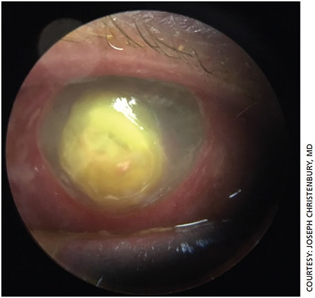 Figure 3. Slit lamp photo of large Fusarium corneal ulcer.