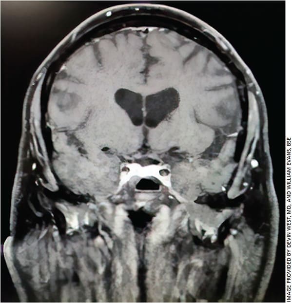 Figure 1. T2 MRI of brain/orbit illustrating involvement of right cavernous sinus.