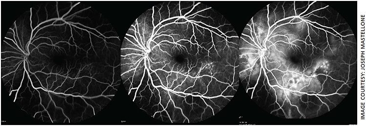 Figure 3. Fundus angiography of the left eye (time-sequenced photos left-to-right) remarkable for initial blocking defect of normal choroidal circulation inferiorly due to sub-retinal fluid followed by early multiple stippled hyperfluorescence with late pooling of fluorescein dye.