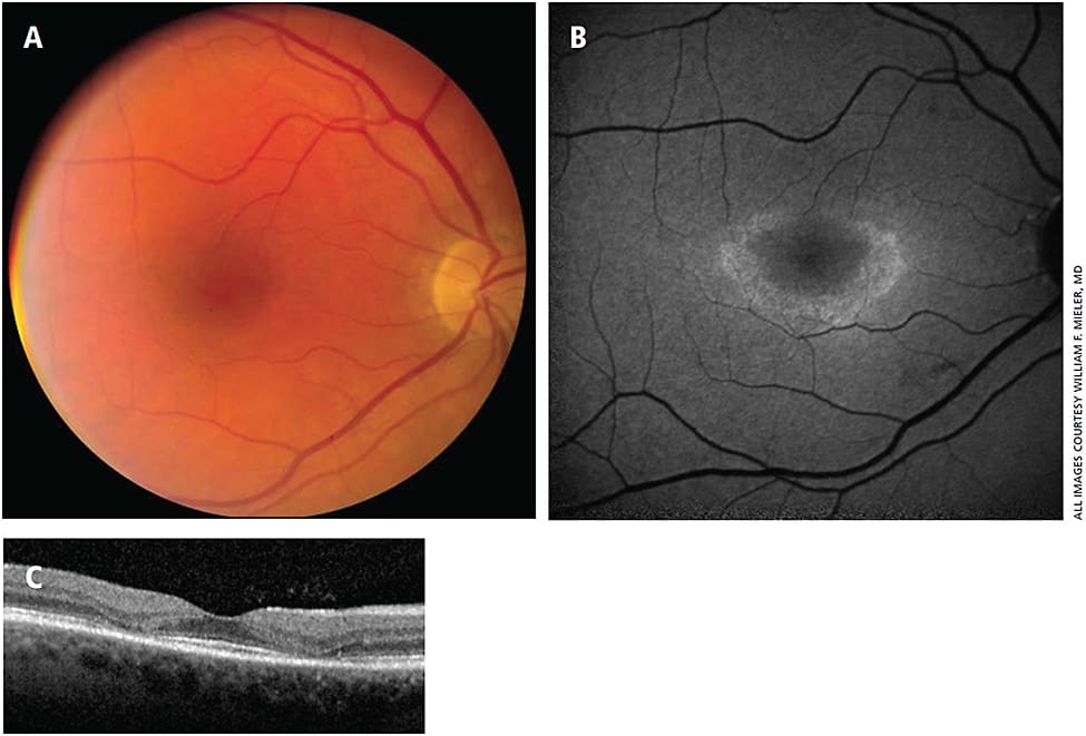 Figure 1. Early hydroxychloroquine toxicity. A 53-year-old female referred for asymptomatic macular pigment mottling. The patient had a history of Sjögren’s syndrome, which was treated with 17 years of hydroxychloroquine therapy at doses as high as 7.5 mg/kg/day. (A) Perifoveal pigmentary changes in the right eye. (B) A bull’s eye pattern of perifoveal hyperautofluorescence. (C) Perifoveal outer retinal and ellipsoid segment attenuation on OCT.