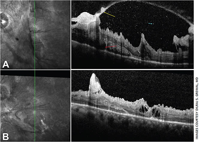 Figure 4. Preoperative OCT showing extensive traction in the macula with overlying fibrovascular tissue (A, yellow arrow), hyperechoic opacities in the vitreous consistent with vitreous hemorrhage (blue arrow) and subretinal fluid in the inferior macula showing a limited tractional retinal detachment (red arrow). Following pars plana vitrectomy (B), there is release of traction, a significant portion of the fibrovascular tissue has been removed, there is improvement in the retinal anatomy and architecture and resolution of the tractional retinal detachment.