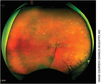 Figure 1. Multifocal, hypopigmented lesions of the right eye.