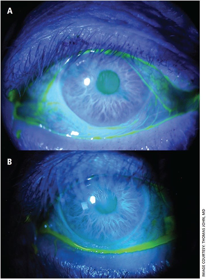 Patient before (A) and after (B) CCh surgery.