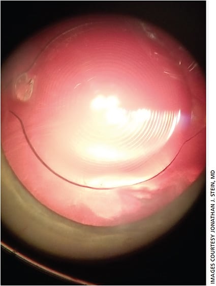 Figure 2. Multifocal IOL immediately after implantation.