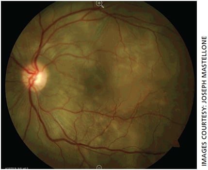 Figure 1. Color fundus photo of the left eye demonstrating cream-colored round choroidal lesions scattered throughout the macula and periphery (Dalen-Fuchs nodules).