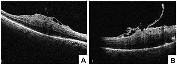 Figure 3. MiOCT (EnFocus) evaluation of epiretinal membrane in the beginning of surgery (A). Real-time feedback during membrane peeling (B)