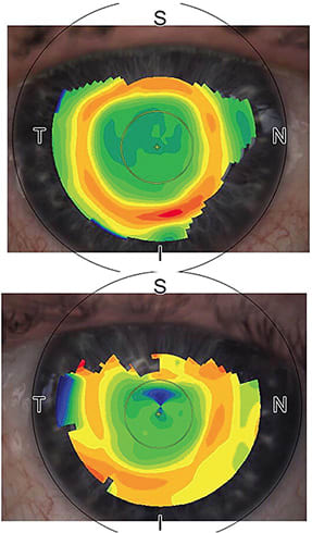 Figure 3. Topography of the patient’s eye before (bottom) and after (top) IPL and thermal radiofrequency tissue tightening.