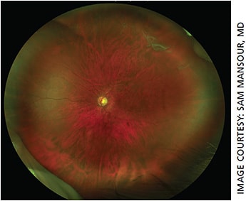 Figure 4. Horseshoe retinal tears in the superotemporal periphery. Left eye fundus color image obtained using the Optos California UWFI SLO camera.
