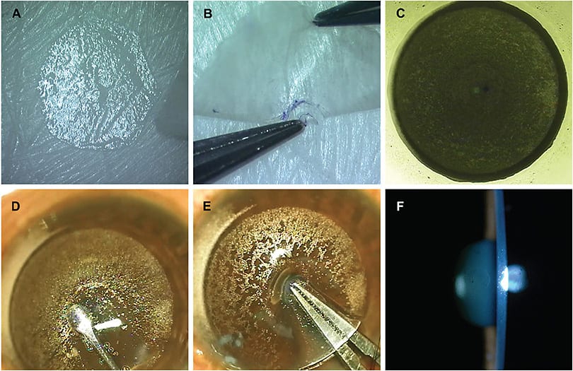 A) A SMILE lenticule is spread out with the correct side facing up; B) A 1-mm PEARL lenticule is punched out from its center; C) A pocket is created with a femtosecond laser in the presbyopic patient’s recipient eye; D) The central part of the pocket is opened; E) The PEARL lenticule is placed within the pocket under the marked, coaxially sighted light reflex; F) Slit-lamp image of the patient’s eye showing the PEARL lenticule in place.