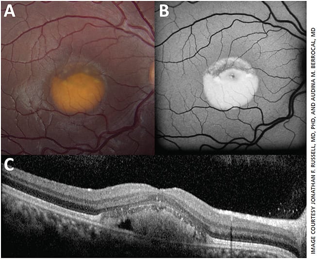 Figure 3. Fundus photograph (A), autofluorescence (B) and OCT (C) in a patient with Best disease. Images obtained via Topcon and Heidelberg devices.