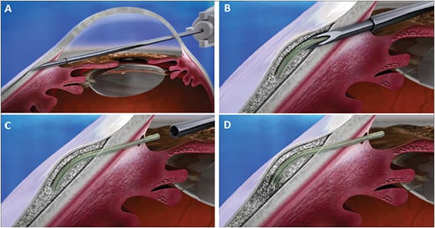 Figure 1. (A-D) The XEN Gel Stent is injected into the subconjunctival space through a small, self-sealing corneal incision using a simple, preloaded IOL-like injector.