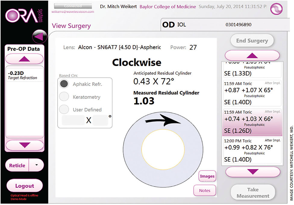 Figure 2. Data acquisition with IA (ORA, Alcon) following toric lens implantation, recommending IOL rotation to achieve maximal reduction of astigmatism.