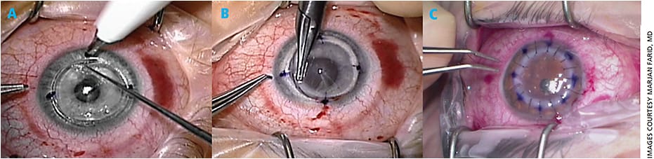 Figure 1A. The radial alignment marks that the laser makes are premarked to allow exact tissue alignment during surgery.
Figure 1B. The anterior, lamellar and posterior side cuts are easily visualized during surgery and guide needle and suture placement.
Figure 1C. Standard suturing technique is employed.