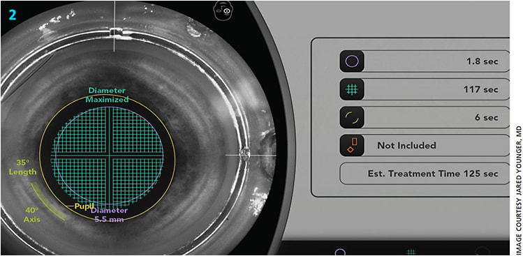 Figure 2. Fragmentation grid spacing is near the maximum in this brunescent cataract case. The change in settings increases the treatment time to 125 seconds in total, most of which is for fragmentation.