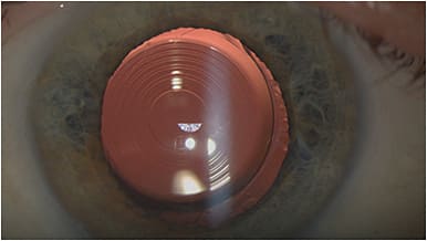 Figure 2b. Well-centered Tecnis Synergy IOL after implantation