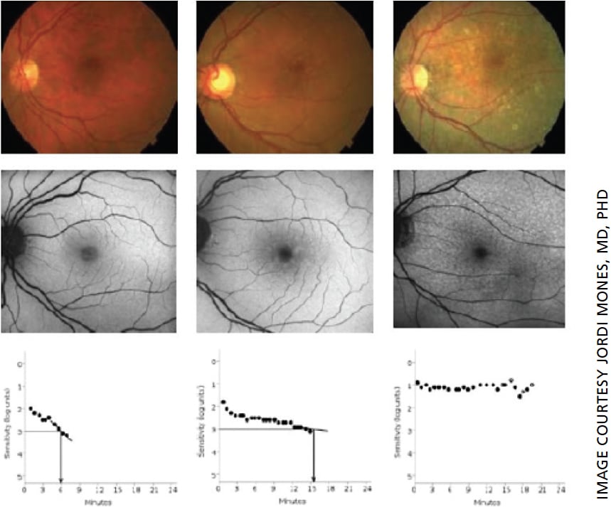 Figure 1. Representative fundus autofluorescence images (top) and dark adaptometry (bottom) images from controls (left), soft drusen (middle) and reticular pseudodrusen (right) individuals.