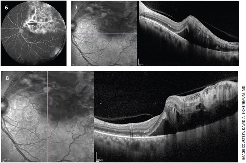 Branch retinal vein occlusion with leakage on angiography (Figure 6) and macular edema on OCT (Figure 7, 8).