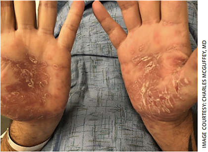 Figure 3. Erythematous, scaly rash of bilateral hands.