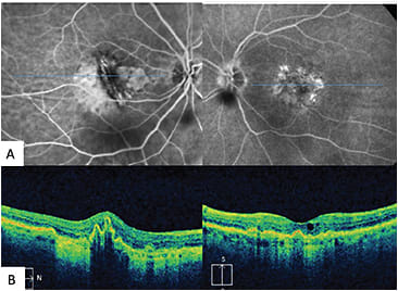 Figure 6. Retinal pigment epithelial tear in neovascular AMD.