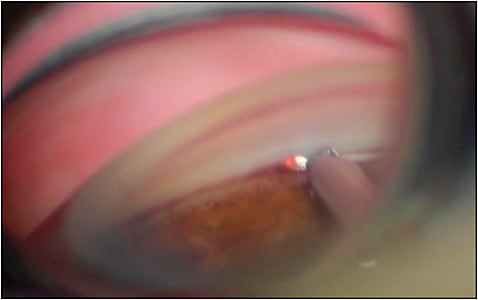 Figure 3. Surgeon’s view of first surgery with Goniotome +I/A. The tip is hovering in 
Schlemm canal and the TM is stretched onto the dual serrated blades and aspirated. Compared to an anterior-chamber maintained by viscoelastic, the view is clear and free 
of blood and debris.