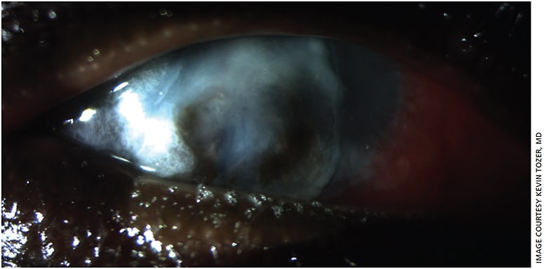 Figure 2. External photograph of cornea at two-week follow-up visit. Temporal (right side of image) corneal glue is present, progressive thinning and plugged perforation noted nasally.