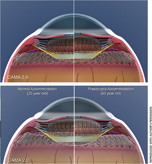 Figure 6. CAMA 2.0 demonstrating effect of presbyopia on 25-year-old (left half) and 50-year-old (right half). The top image shows structures in disaccommodation, and the bottom image shows structures in accommodation.