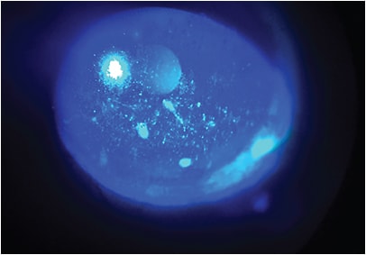 Figure 2. Significant corneal fluorescein staining due
to severe dry eye.