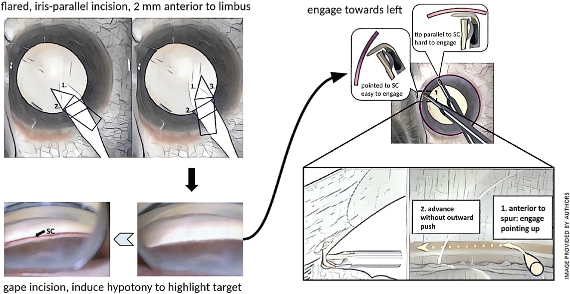 Figure 2. Steps of Trabectome surgery (from left to right): With the patient looking up into the microscope and the surgeon in temporal position, a clear corneal incision is fashioned that is parallel to the iris and relatively anterior (2 mm) to prevent iris prolapse. After the head is rotated away by 30° and the microscope is tilted towards the surgeon by the same amount, the incision is gaped to allow fluid egress and hypotony. This will cause reflux of venous blood into Schlemm’s canal and highlight the ablation target. The Trabectome is inserted and the TM is engaged towards the left, pointing up in a 45° angle. After entering Schlemm’s canal, the surgeon should keep the tip parallel to the TM and avoid outward pressure.